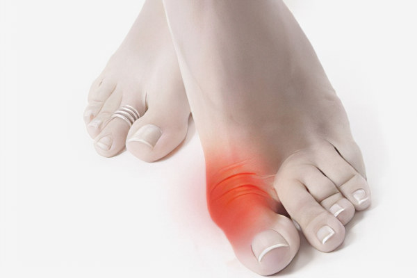 Лечение шишек на ногах при подагре