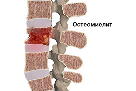 Причины остеомиелита