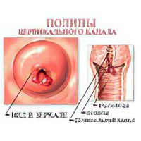 Причины возникновения, удаление и лечение полипа цервикального канала