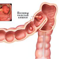 Полип в прямой кишке