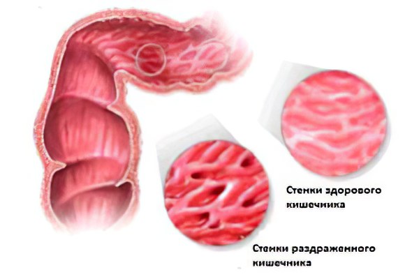 синдром раздражённого кишечника