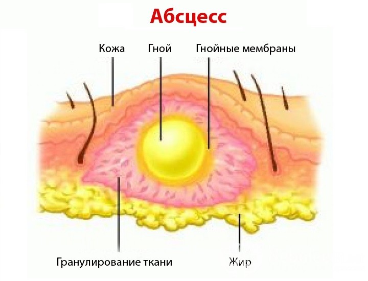 абсцесс