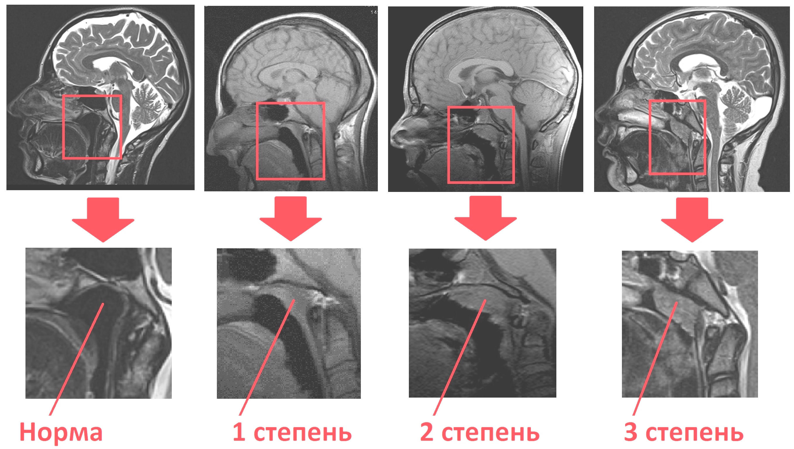 Степени аденоидов в носу