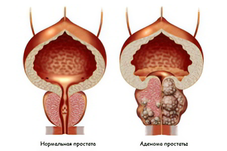 Adenom de prostata: cauze, simptome, complicatii, tratament | Bioclinica