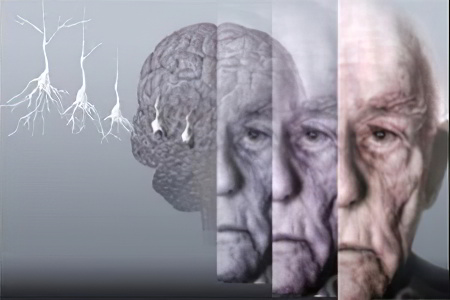 Стадии болезни Альцгеймера