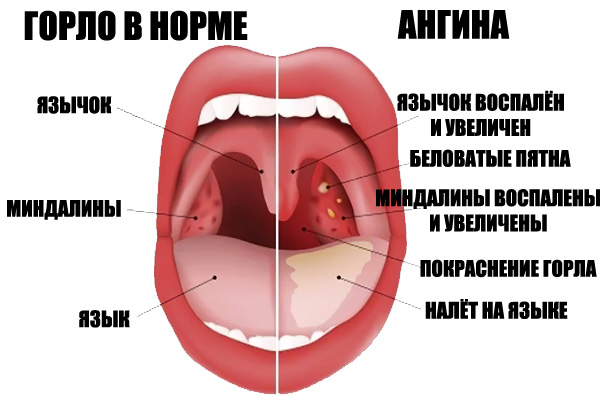 angina simptomi