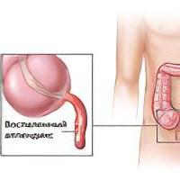 Как вылечить аппендицит народными средствами