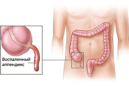аппендицит