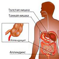 Как вылечить аппендицит в домашних условиях