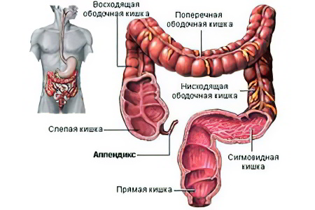 Аппендицит