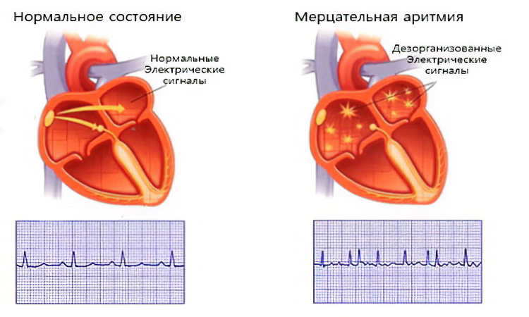 Нормальное состояние и аритмия