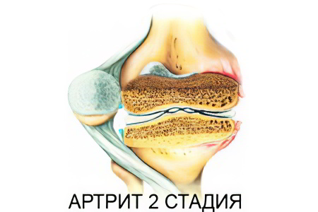 2 степень артрита 2 степень артрита