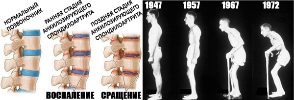 Анкилозирующий спондилоартрит