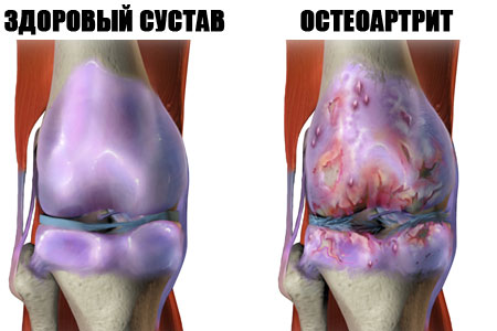 Остеоартрит