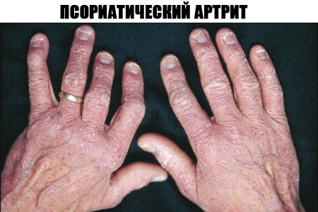 Псориатический артрит