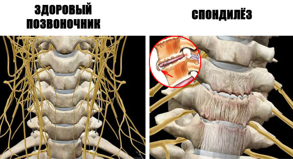 Спондилёз