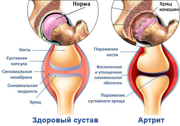 Артрит и здоровый сустав