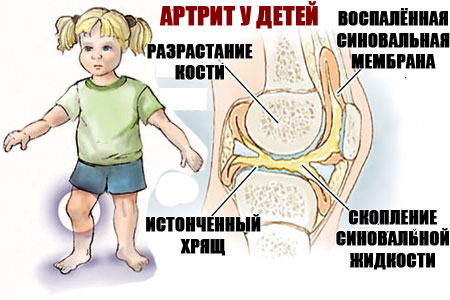 Ювенильный идиопатический артрит