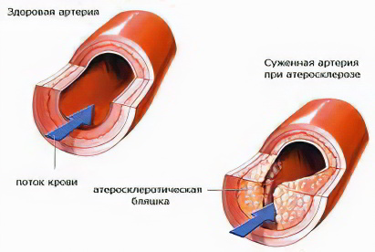 http://www.ayzdorov.ru/images/chto/ateroskleroz2.jpg