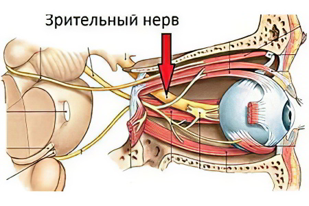 Атрофия зрительного нерва Атрофия зрительного нерва