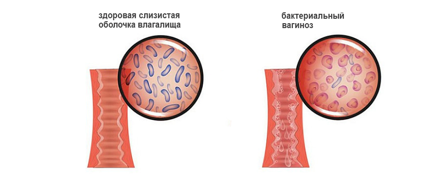 Бактериальный вагиноз