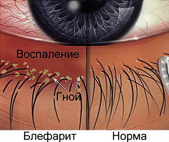 Блефарит Блефарит
