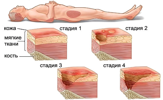 Пролежни