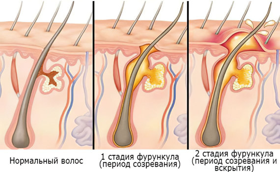 Фурункул