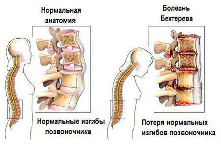 Изображение - Хроническое заболевание суставов bolezn-behtereva4657