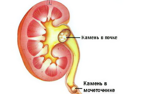 почек и мочевого пузыря