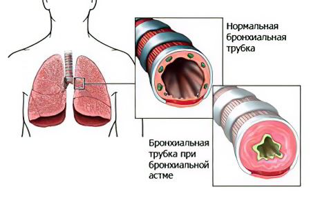 Бронхиальная астма