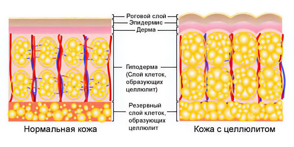 целлюлит