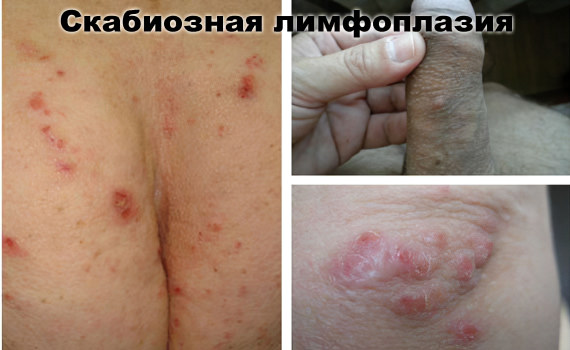 Скабиозная лимфоплазия кожных покровов
