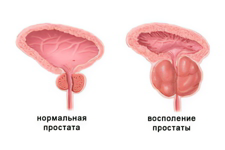 Что такое простатит