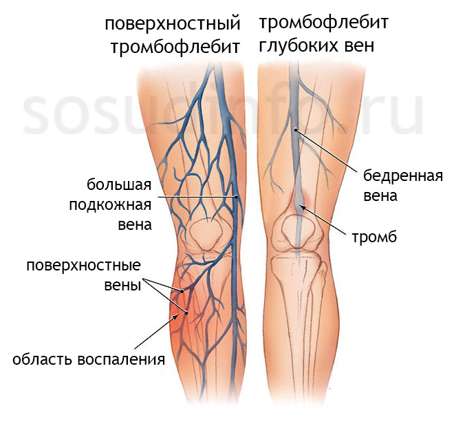 Тромбофлебит поверхностный и глубоких вен