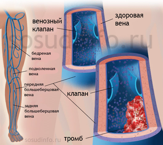 Здоровая вена и вена с тромбом при тромбофлебите