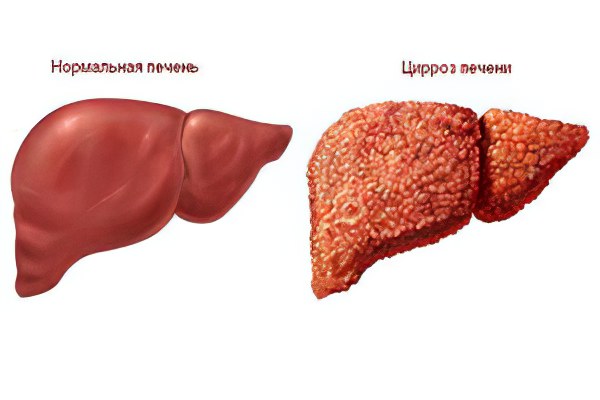 Цирроз печени