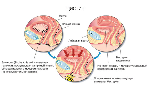 Цистит