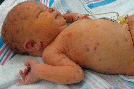 Вред цитомегаловируса для новорождённых