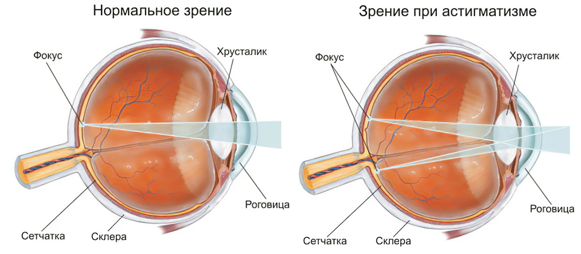 Дальнозоркость