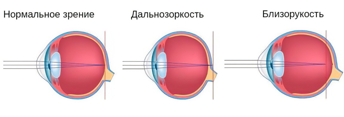 дальнозоркость