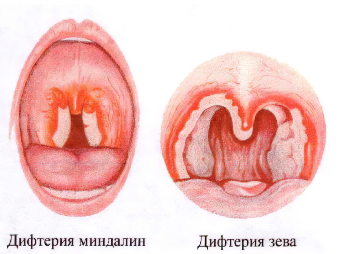 Дифтерия зева токсическая