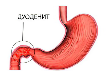 Дуоденит