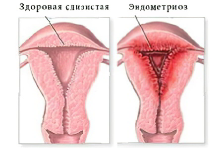 Эндометриоз матки