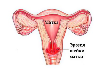 Эрозия шейки матки