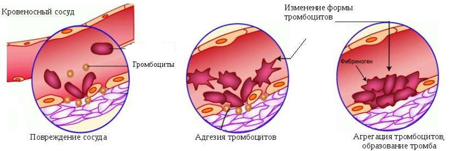 этапы образования тромба