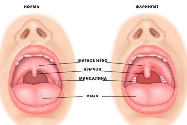 Фарингит