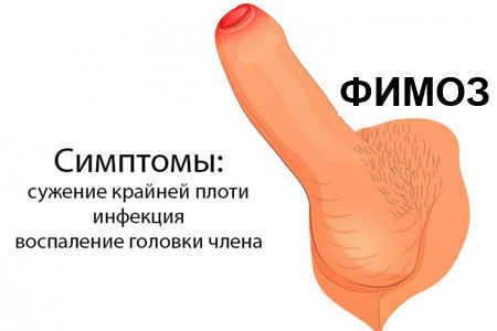 Что такое фимоз? Что такое фимоз?