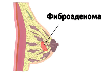 Фиброаденома молочной железы