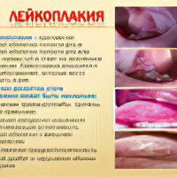 Заболевание шейки матки лейкоплакия лечение народными средствами thumbnail